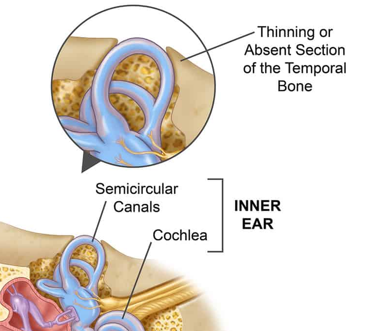 Image of the semicircular canals in the inner ear